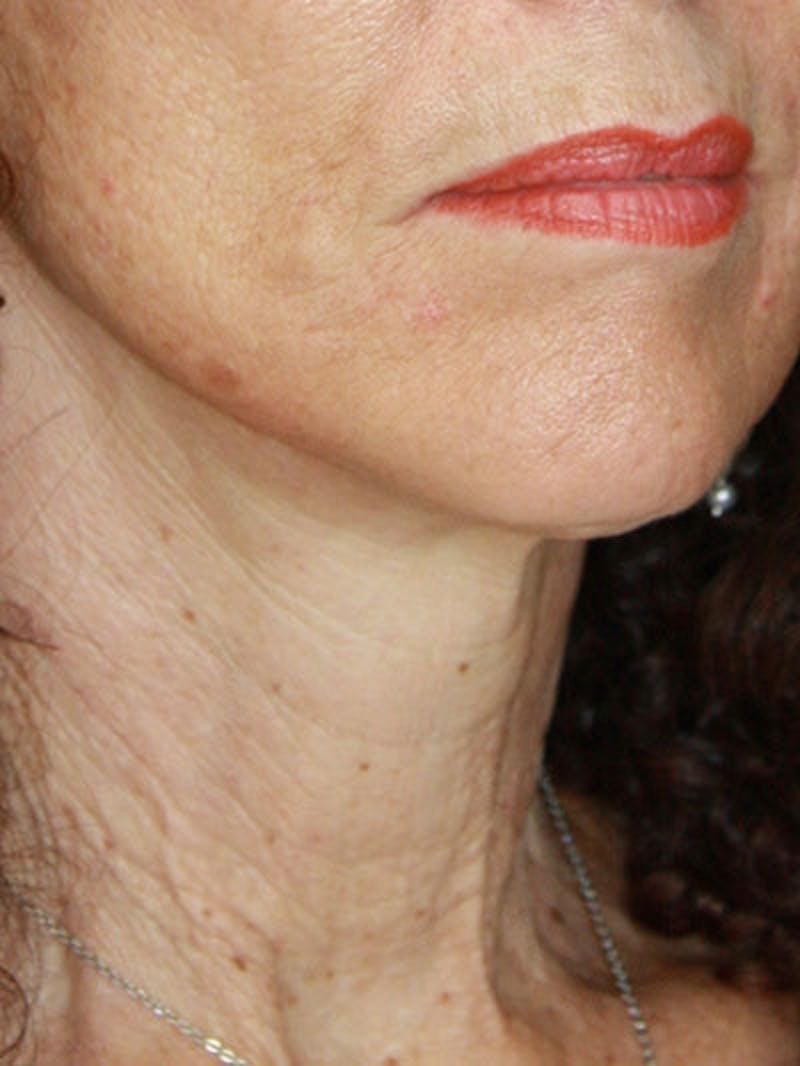 Facelift & Neck Lift Before & After Gallery - Patient 177555042 - Image 4