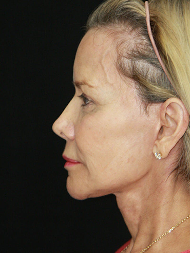 Facelift & Neck Lift Before & After Gallery - Patient 143521872 - Image 10