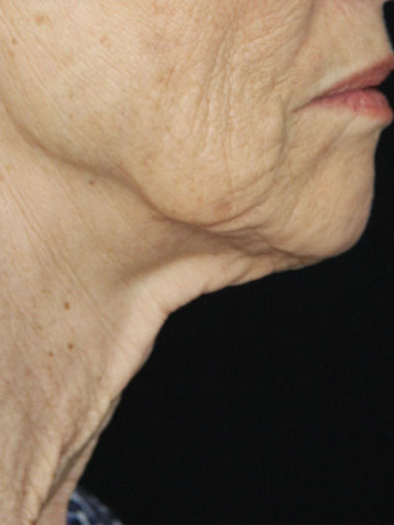 Facelift & Neck Lift Before & After Gallery - Patient 177555042 - Image 5