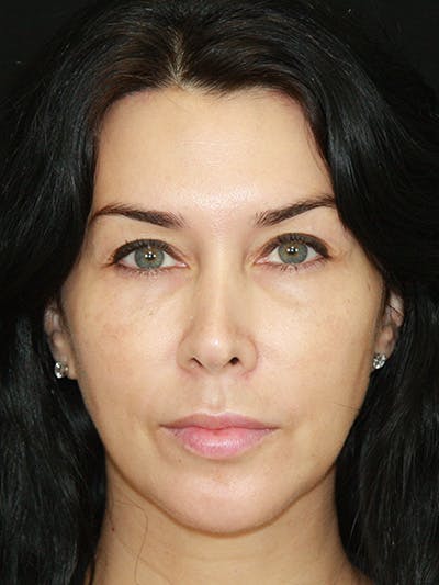 Brow Lift Before & After Gallery - Patient 143521874 - Image 2