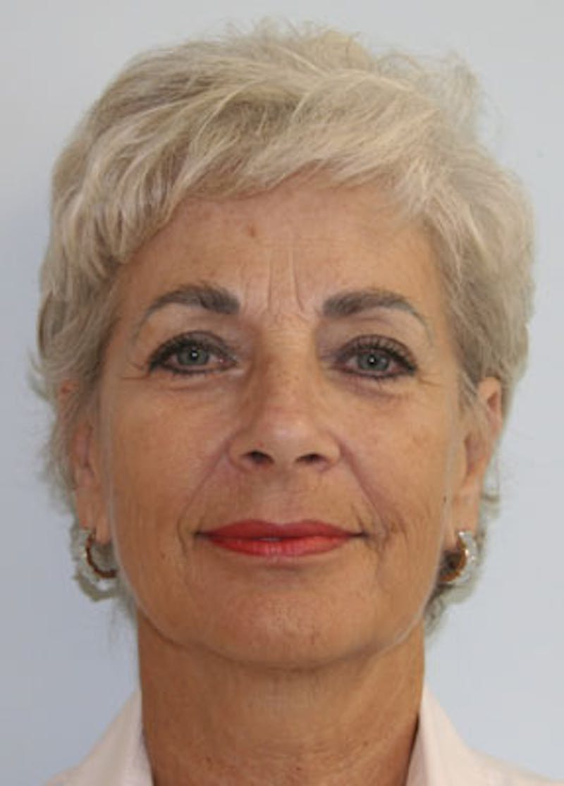 Fat Grafting Before & After Gallery - Patient 143521877 - Image 1