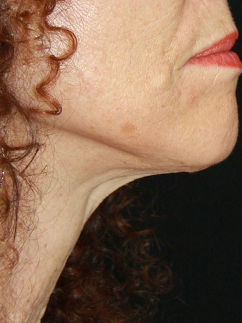 Facelift & Neck Lift Before & After Gallery - Patient 177555042 - Image 6