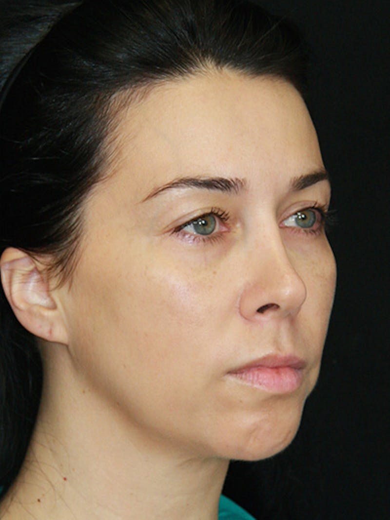 Brow Lift Before & After Gallery - Patient 143521874 - Image 3