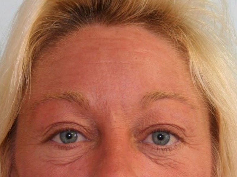 Eyelid Surgery Before & After Gallery - Patient 143521873 - Image 1