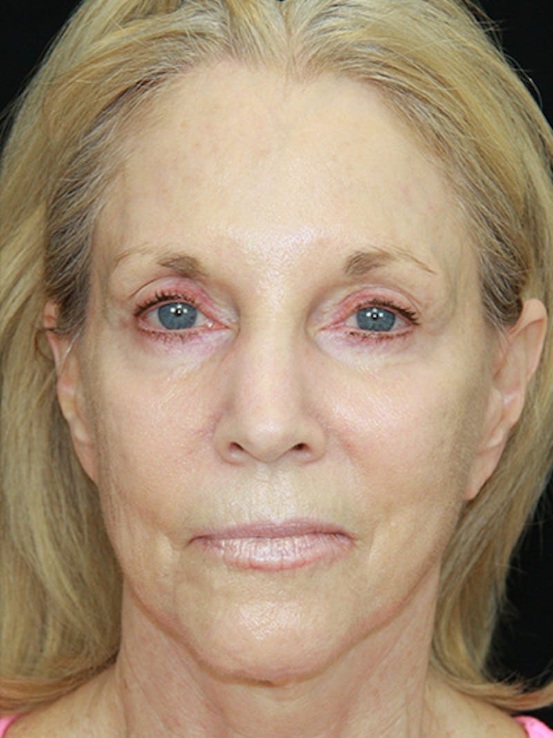 Facelift & Neck Lift Before & After Gallery - Patient 143521883 - Image 1