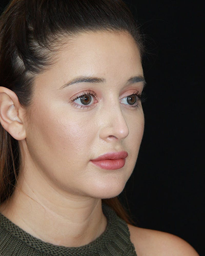 Rhinoplasty Before & After Gallery - Patient 143521876 - Image 4