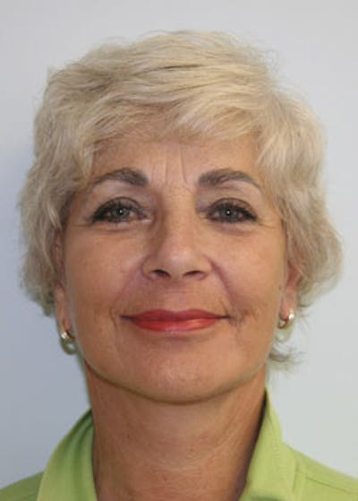 Fat Grafting Before & After Gallery - Patient 143521877 - Image 2