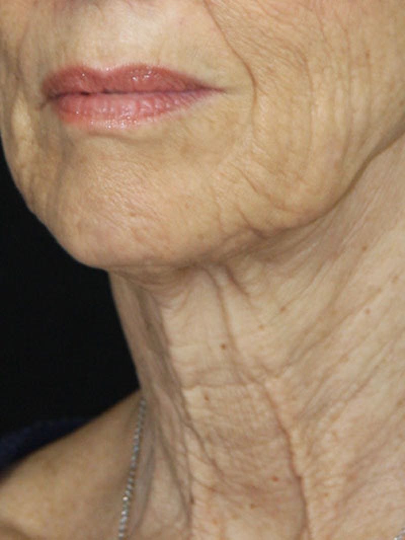 Facelift & Neck Lift Before & After Gallery - Patient 177555042 - Image 7