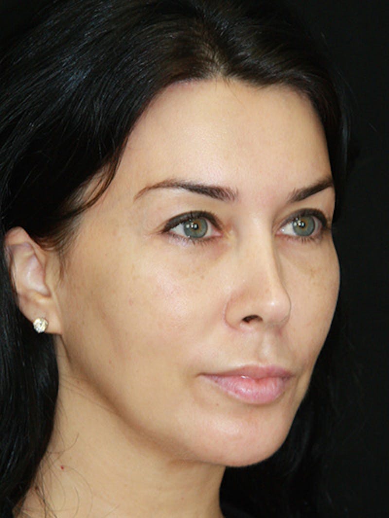 Brow Lift Before & After Gallery - Patient 143521874 - Image 4