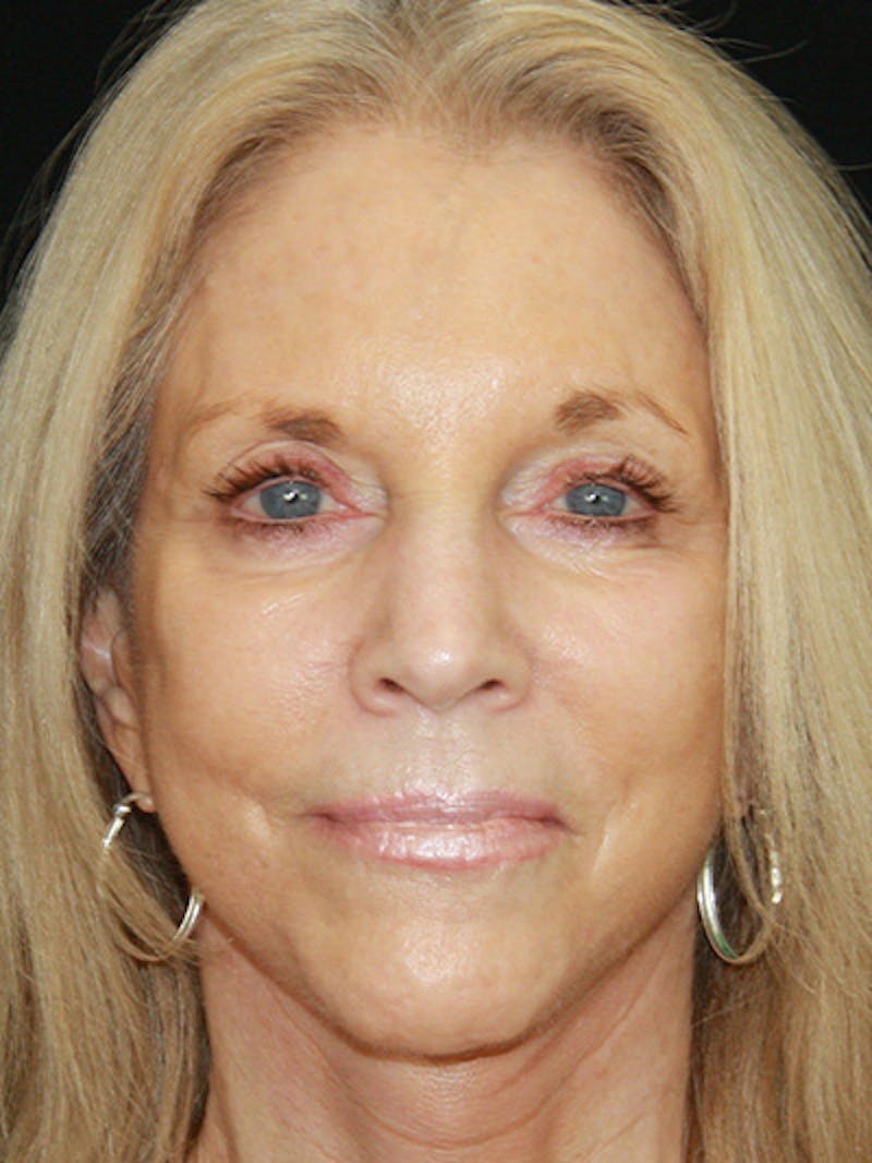 Facelift & Neck Lift Before & After Gallery - Patient 143521883 - Image 2