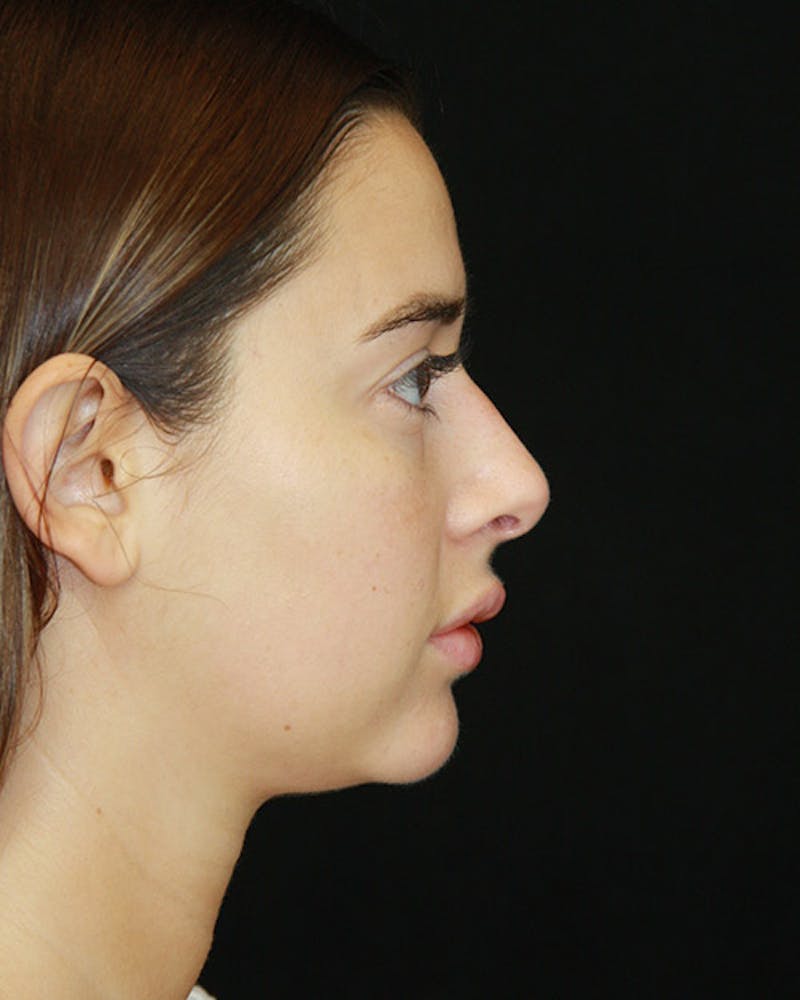 Rhinoplasty Before & After Gallery - Patient 143521876 - Image 5