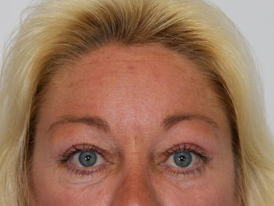 Eyelid Surgery Before & After Gallery - Patient 143521873 - Image 2