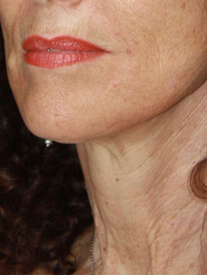Facelift & Neck Lift Before & After Gallery - Patient 177555042 - Image 8