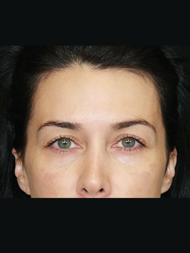 Brow Lift Before & After Gallery - Patient 143521874 - Image 5