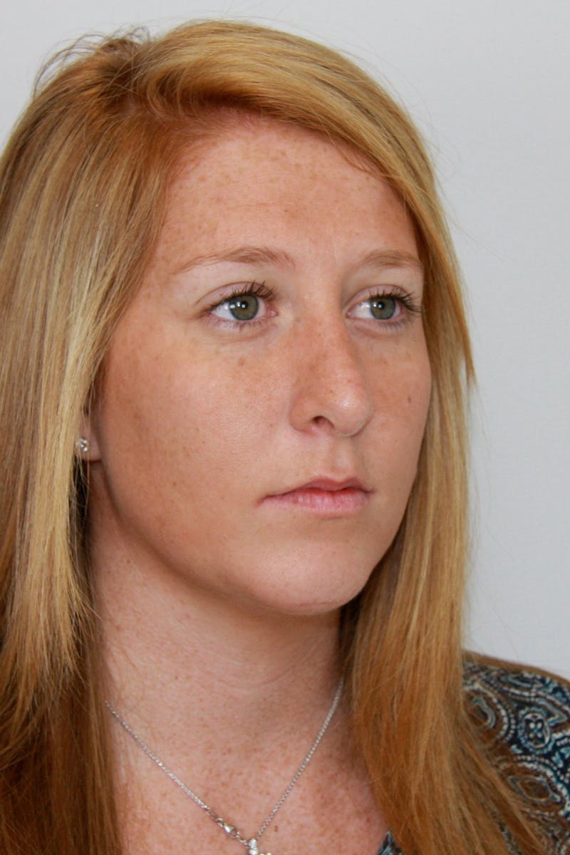 Chin Augmentation Before & After Gallery - Patient 143521889 - Image 4