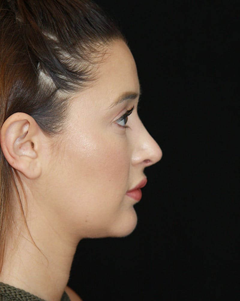 Rhinoplasty Before & After Gallery - Patient 143521876 - Image 6