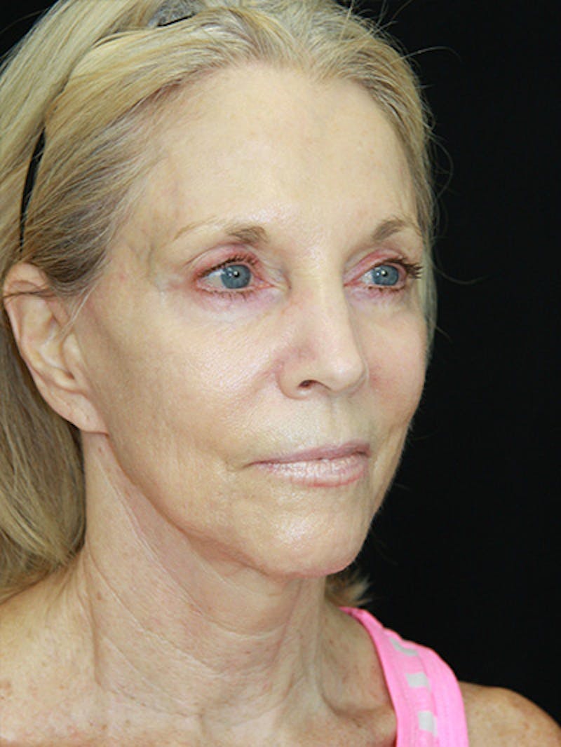 Facelift & Neck Lift Before & After Gallery - Patient 143521883 - Image 3