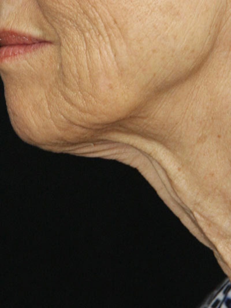 Facelift & Neck Lift Before & After Gallery - Patient 177555042 - Image 9