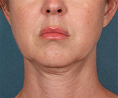 Kybella Before & After Gallery - Patient 143521881 - Image 1