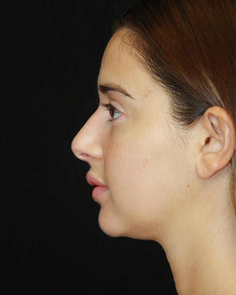 Rhinoplasty Before & After Gallery - Patient 143521876 - Image 7