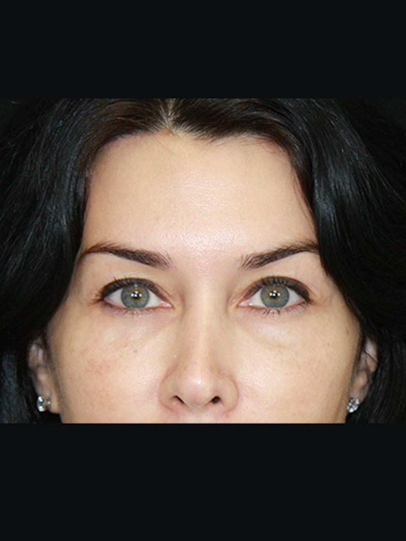 Brow Lift Before & After Gallery - Patient 143521874 - Image 6