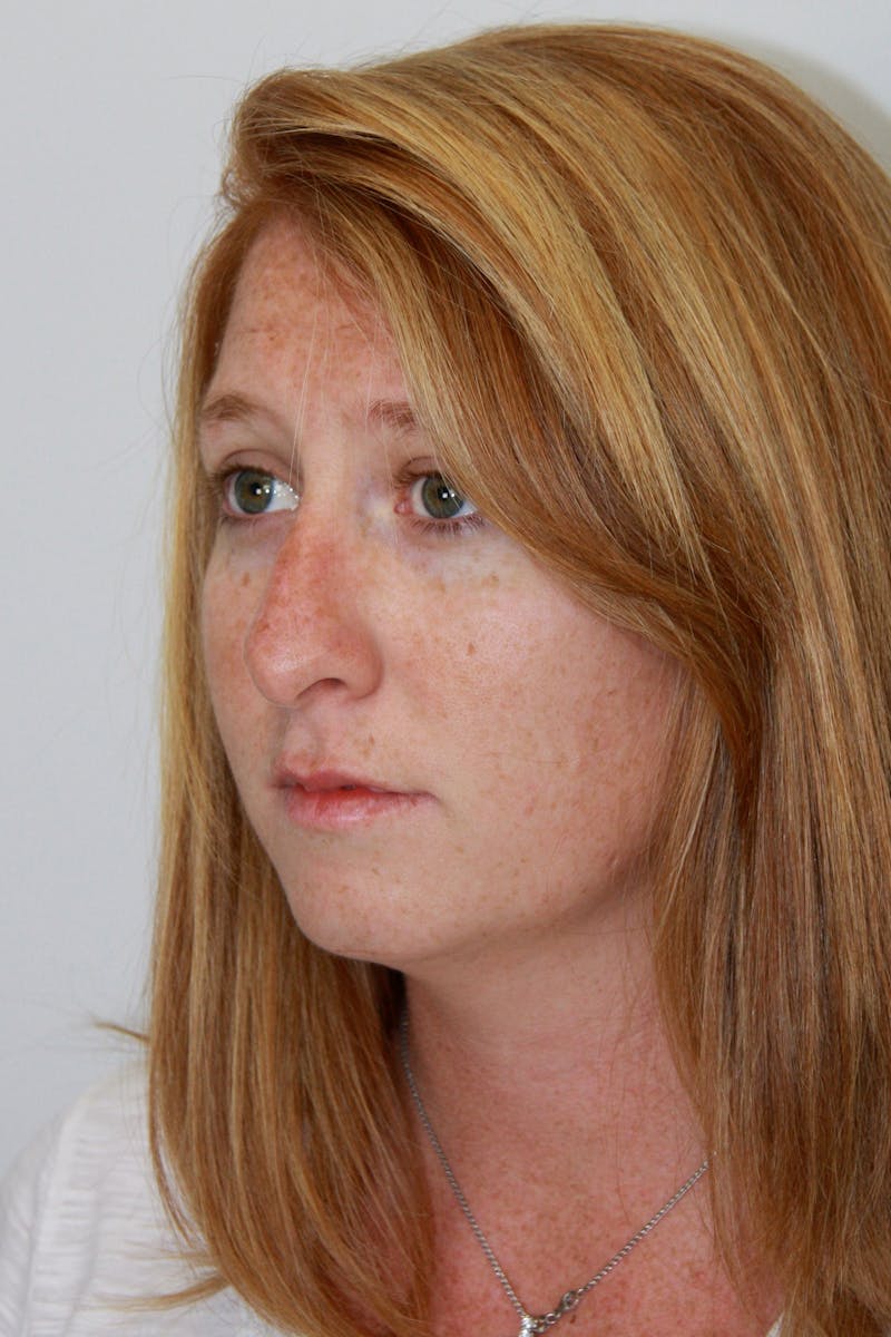 Chin Augmentation Before & After Gallery - Patient 143521889 - Image 5