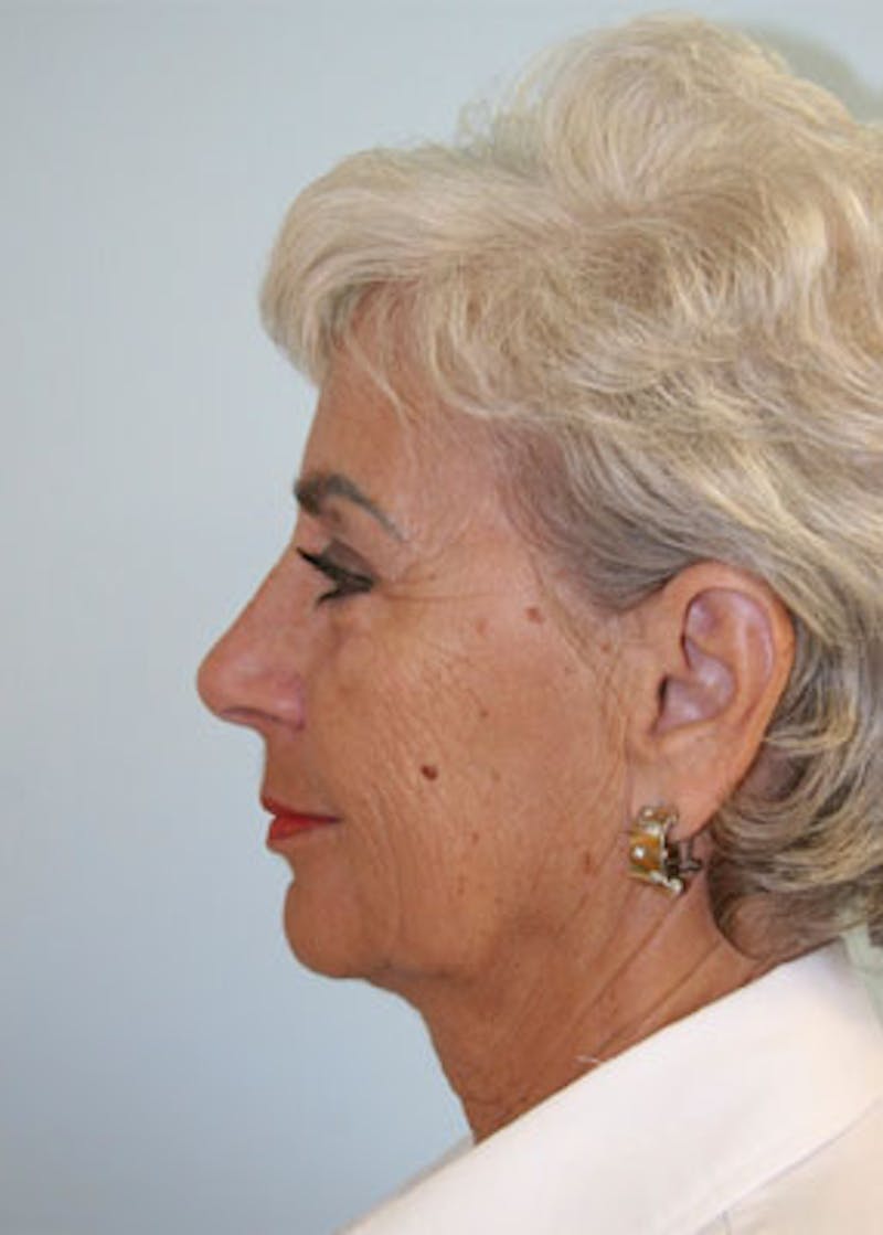 Fat Grafting Before & After Gallery - Patient 143521877 - Image 5