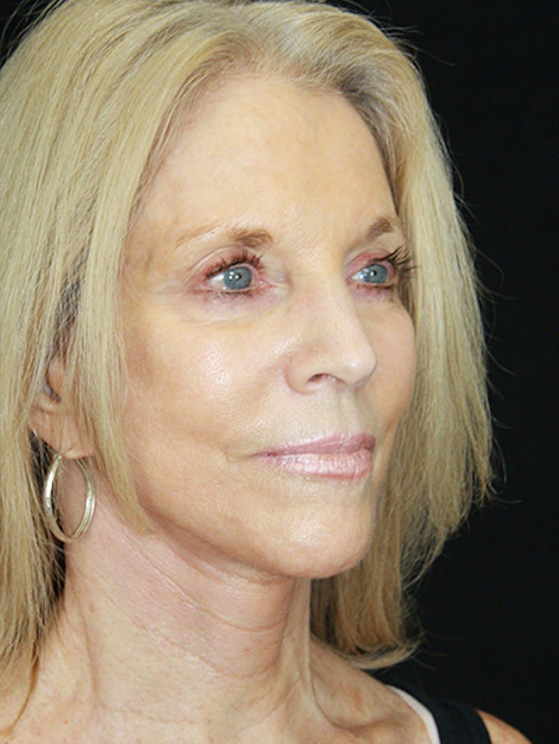 Facelift & Neck Lift Before & After Gallery - Patient 143521883 - Image 4