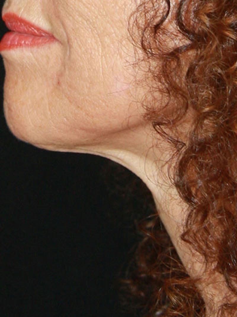 Facelift & Neck Lift Before & After Gallery - Patient 177555042 - Image 10