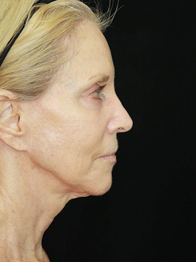 Facelift & Neck Lift Before & After Gallery - Patient 143521883 - Image 5