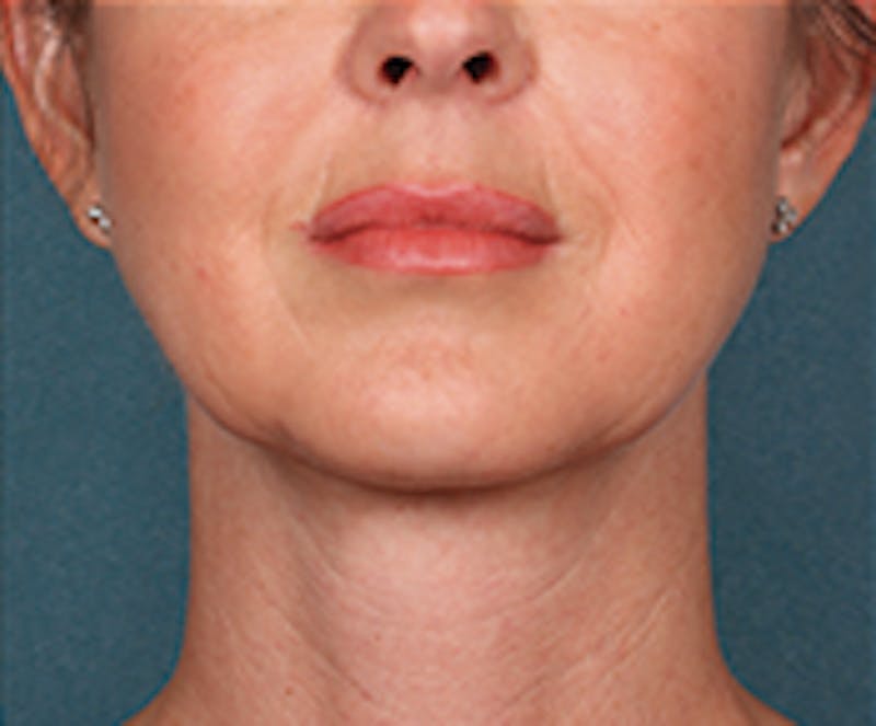 Kybella Before & After Gallery - Patient 143521881 - Image 2