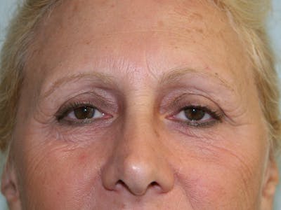Eyelid Surgery Before & After Gallery - Patient 143521884 - Image 1
