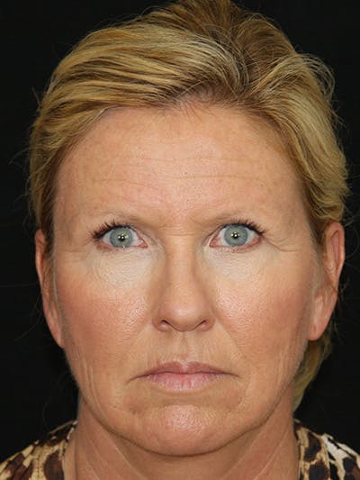 Brow Lift Before & After Gallery - Patient 143521879 - Image 1