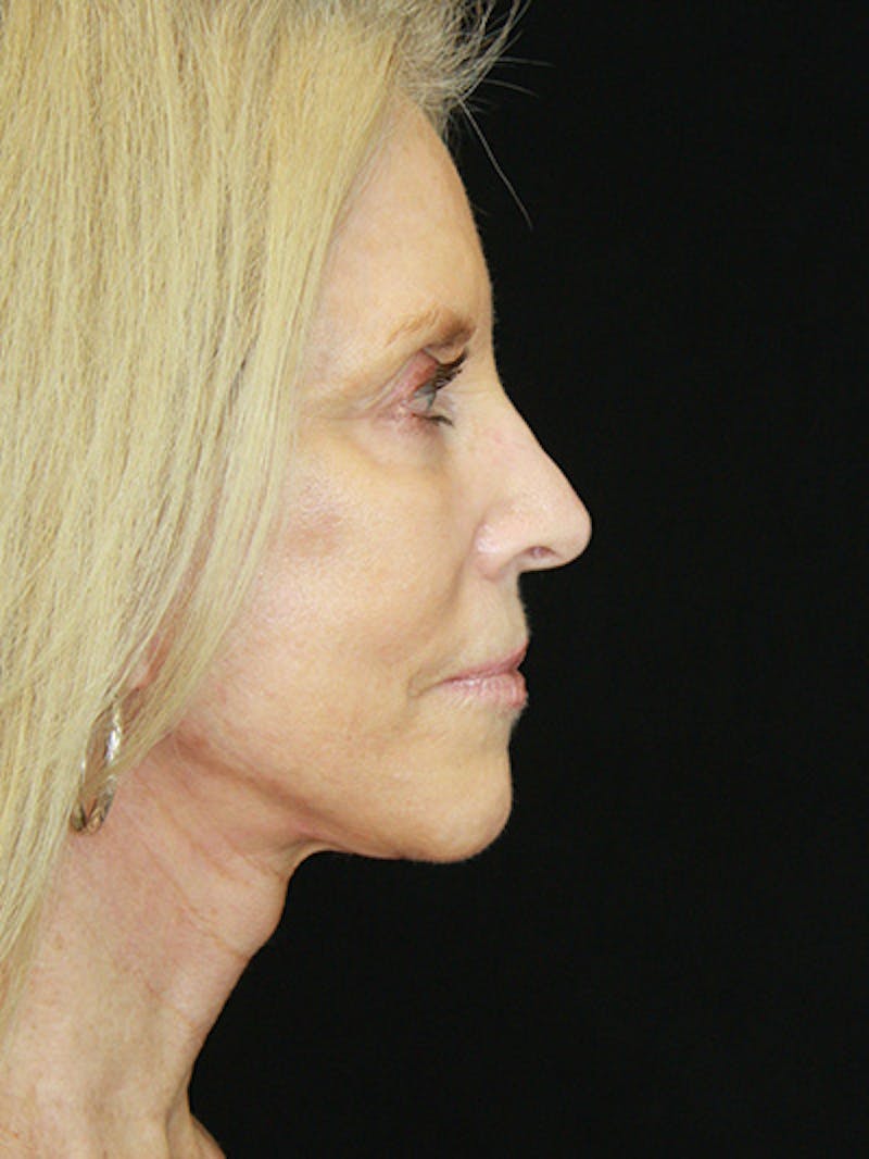 Facelift & Neck Lift Before & After Gallery - Patient 143521883 - Image 6
