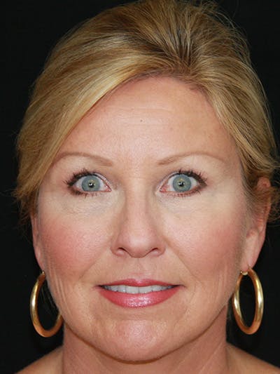 Brow Lift Before & After Gallery - Patient 143521879 - Image 2
