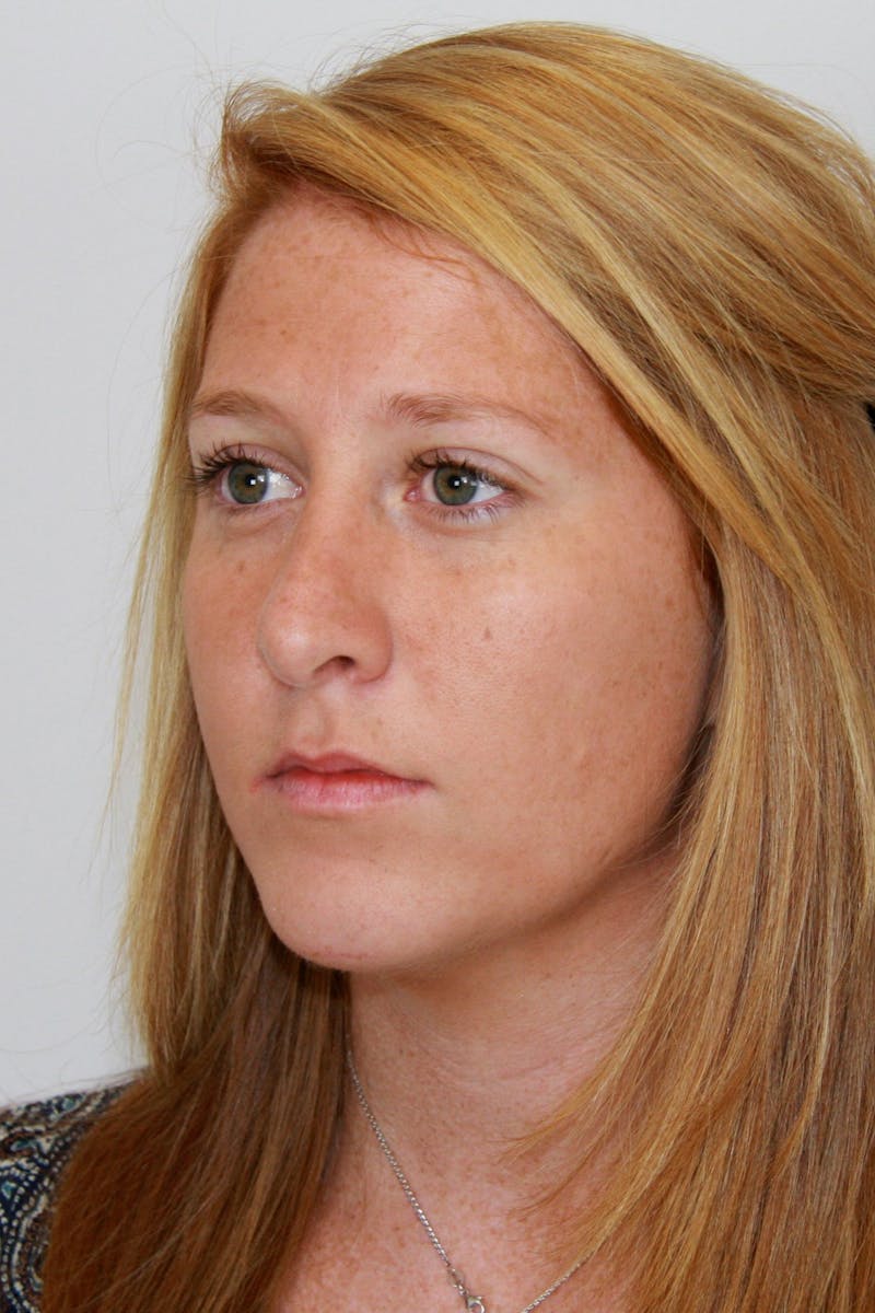 Chin Augmentation Before & After Gallery - Patient 143521889 - Image 6