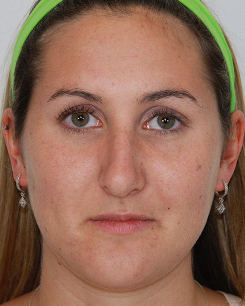 Rhinoplasty Before & After Gallery - Patient 143521890 - Image 1