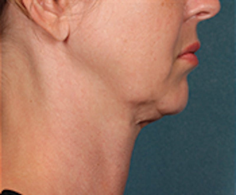 Kybella Before & After Gallery - Patient 143521881 - Image 3