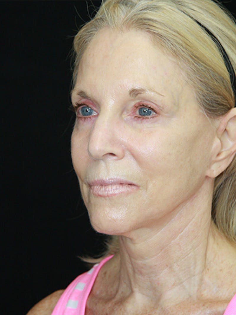 Facelift & Neck Lift Before & After Gallery - Patient 143521883 - Image 7