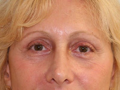 Eyelid Surgery Before & After Gallery - Patient 143521884 - Image 2