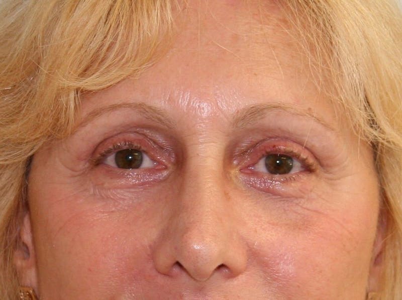 Eyelid Surgery Before & After Gallery - Patient 143521884 - Image 2
