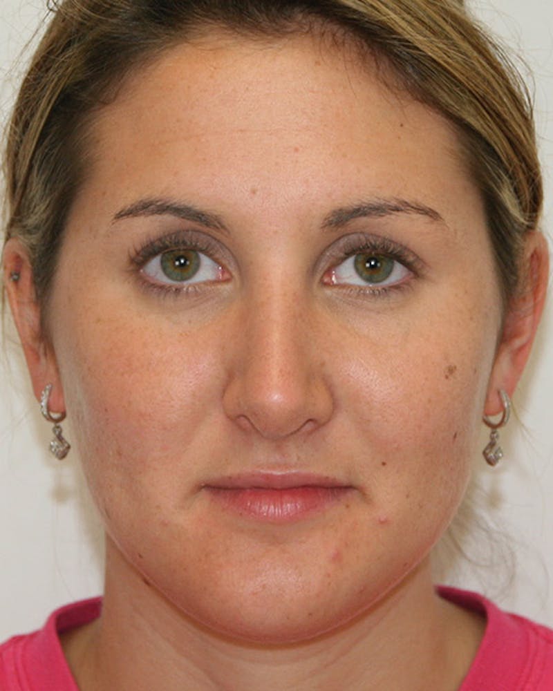 Rhinoplasty Before & After Gallery - Patient 143521890 - Image 2