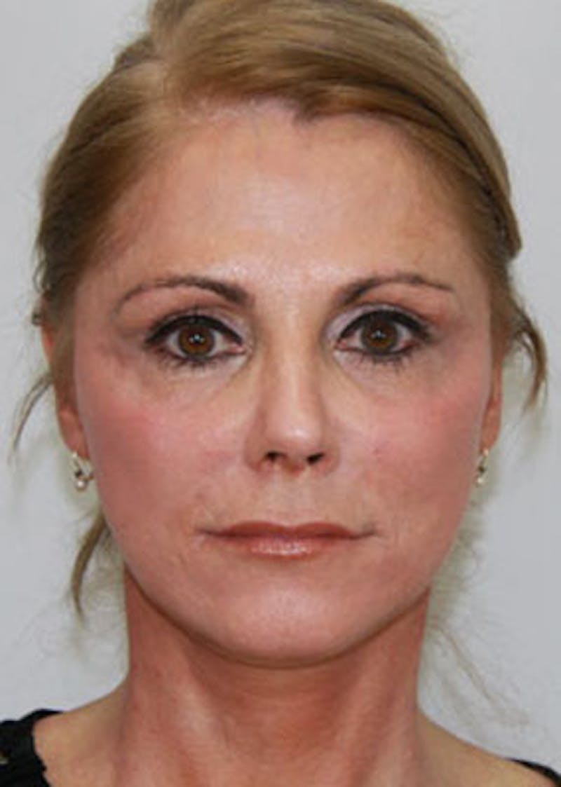 Fat Grafting Before & After Gallery - Patient 143521885 - Image 2