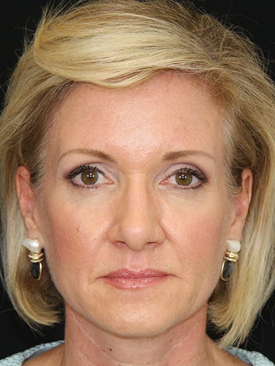 Brow Lift Before & After Gallery - Patient 143521882 - Image 1