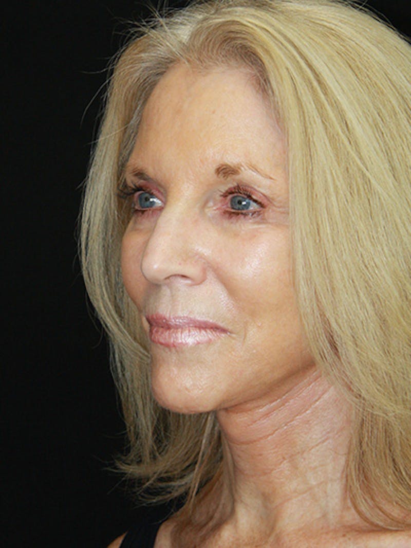 Facelift & Neck Lift Before & After Gallery - Patient 143521883 - Image 8