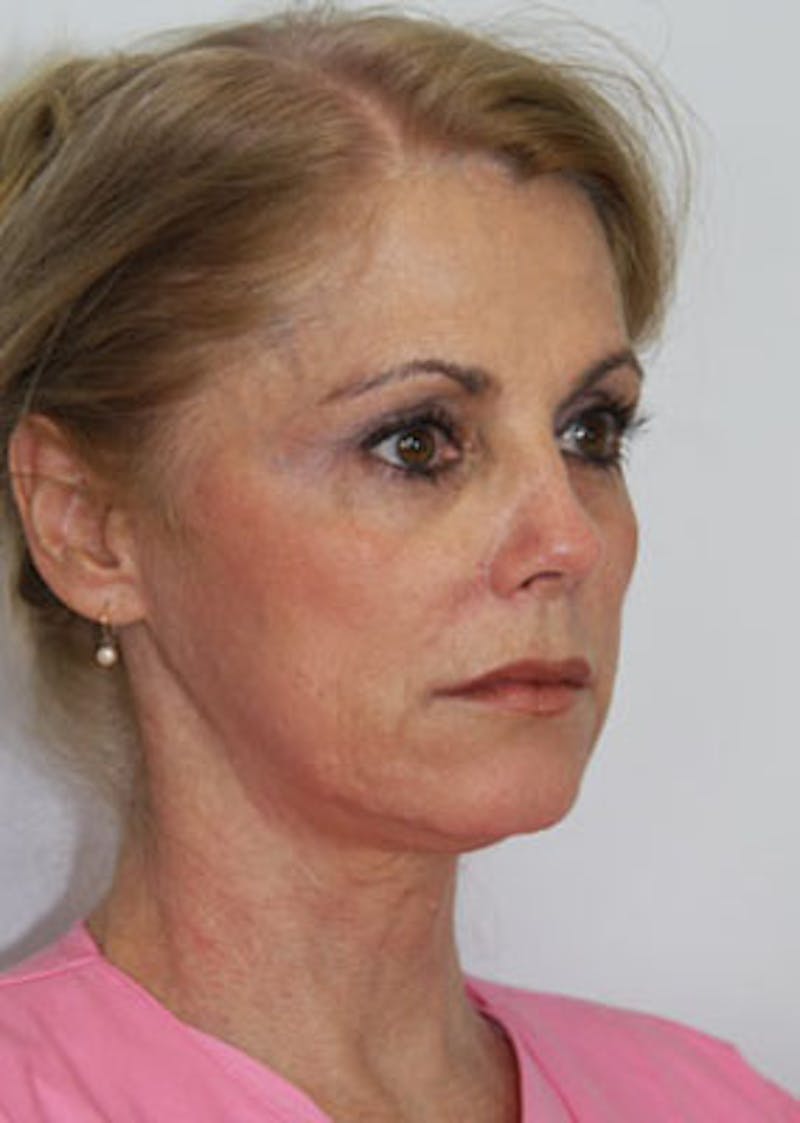 Fat Grafting Before & After Gallery - Patient 143521885 - Image 3