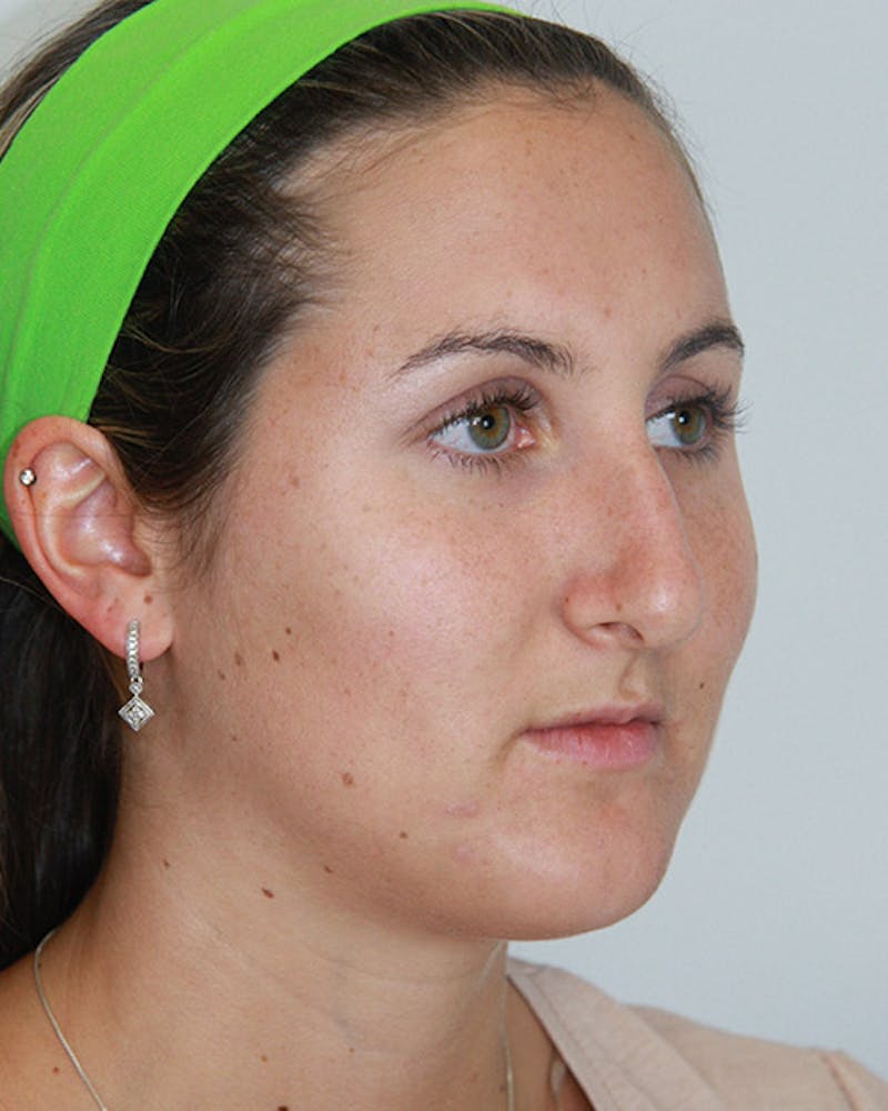 Rhinoplasty Before & After Gallery - Patient 143521890 - Image 3