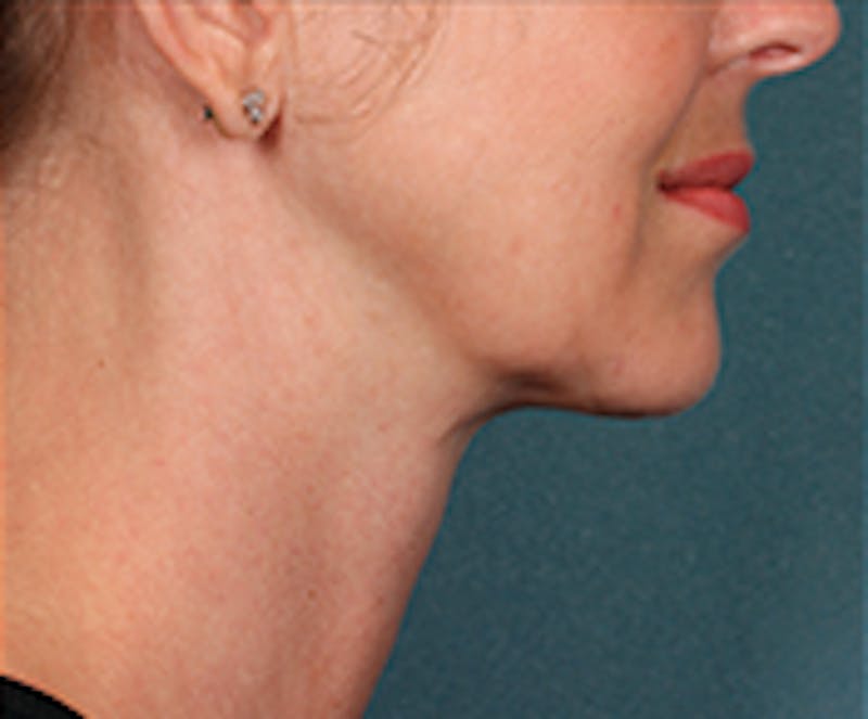 Kybella Before & After Gallery - Patient 143521881 - Image 4