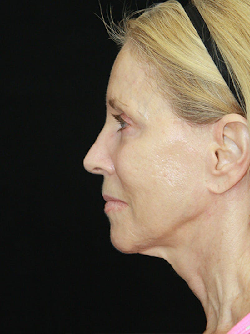 Facelift & Neck Lift Before & After Gallery - Patient 143521883 - Image 9