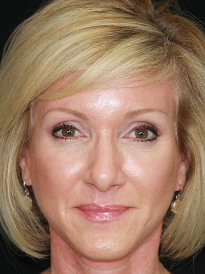 Brow Lift Before & After Gallery - Patient 143521882 - Image 2